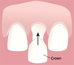 Crowns, Treatment for Restoring Your Tooth