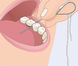 Flossing Crowns