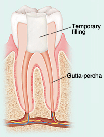 Root Canal Therapy, Understanding