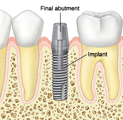 Dental Implants: Placing Abutments and Making Your Prosthesis