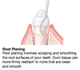 Scaling and Root Planing